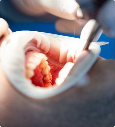 Soft Tissue Graft (Gum Graft Surgery)