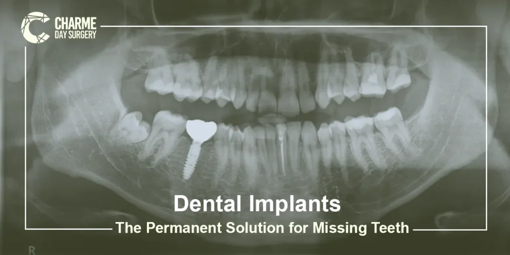 Dental Implants