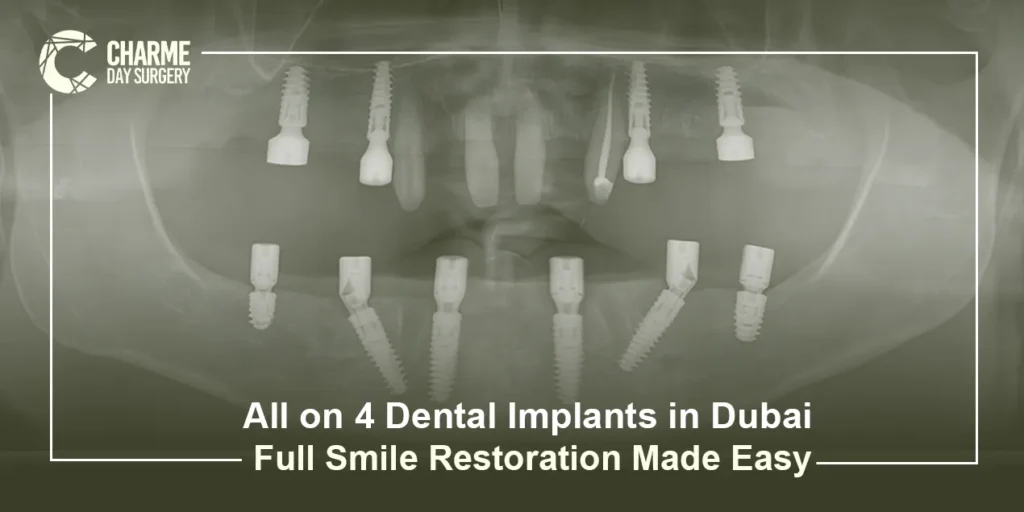 All-on-4 dental implants in Dubai